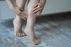 Major Types Of Insects That Can Cause Allergic Reactions