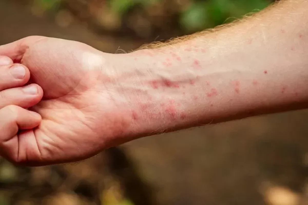 4-common-pest-bites-and-how-to-identify-their-symptoms