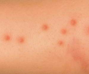 bed-bug-bites bed-bug-bites